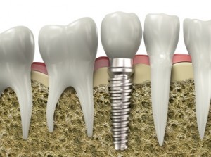 Hampton Dental Implants