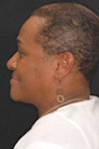 Patient 3 weeks after getting The Denture Fountain of Youth® denture system near Hampton Roads.