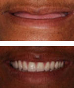 Before and After The Denture Fountain of Youth® - closeup