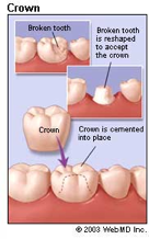 Dental Crowns