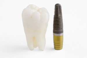 Dental Implants at Port Warwick Dental Arts