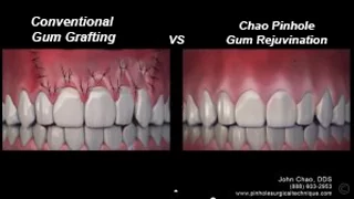 Close up showing how conventional gum grafting works vs. the pinhole surgical technique offered by Dr. Samaha in Newport News.