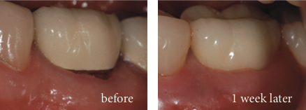 Close up of Dr. Samaha’s Hampton Roads patient's receding gums before and after the pinhole surgical technique.