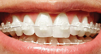 Close up of Six Month Smiles braces available to patients in Newport News and Hampton Roads.